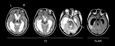 Pharmacotherapy of Traumatic Childhood Aphasia: Beneficial Effects of Donepezil Alone and Combined With Intensive Naming Therapy